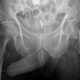 Radiografía de una fractura de pene